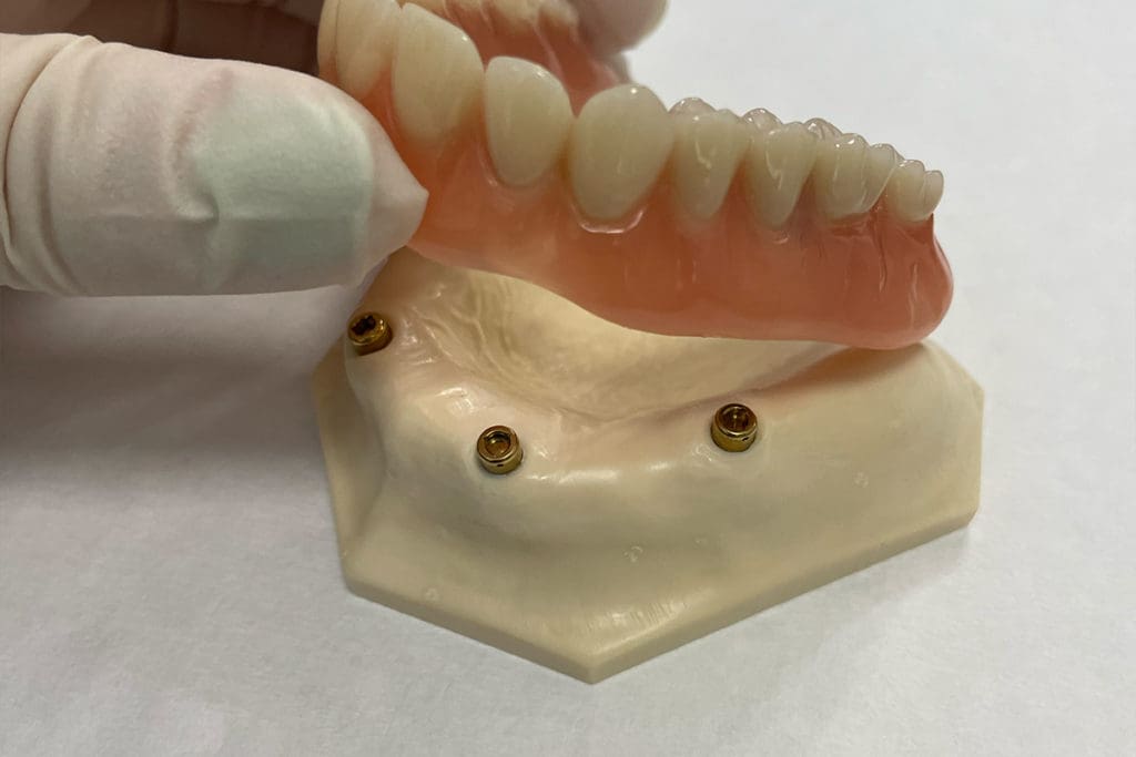 Feste Zähne an einem Tag 2 Feste Zähne an einem Tag 1